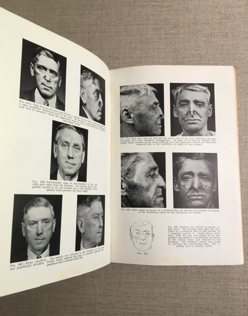 Early Plastic Surgery Book by WWI Allied Surgeon Jacques Maliniak - Image 4